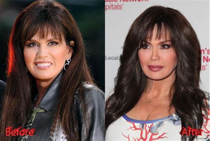 Marie Osmond Facelift